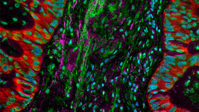 lung cancer desmoplasia